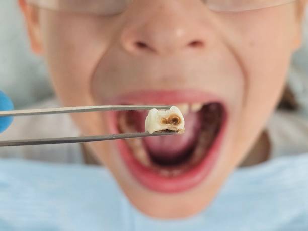 Best Emergency Tooth Extraction in Union City, GA