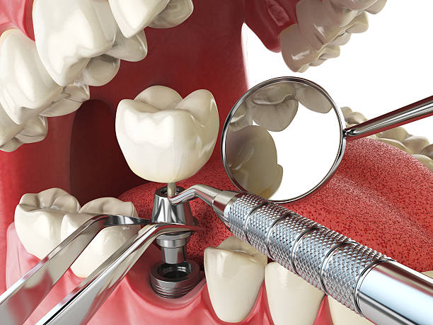 Best Urgent Care for Lost Fillings or Crowns in Union City, GA